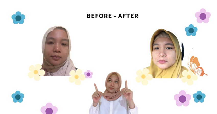 before after pemakaian retinol